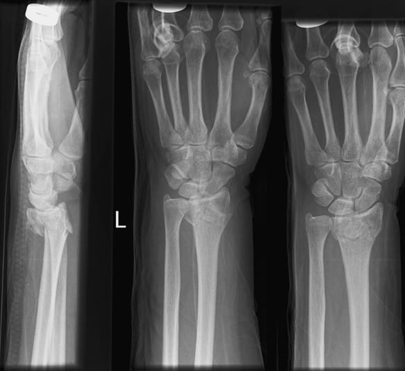 colles fracture osteoporosis