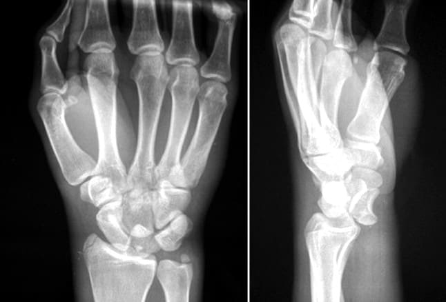 Colles’ Fracture - Pictures, Treatment, Healing Time, Surgery, Symptoms ...