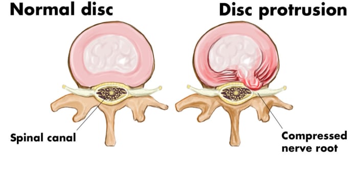 What is disc protrusion? On the left is a cross section of a normal disc; on the right is a cross section of a protruding, or herniated, disc.