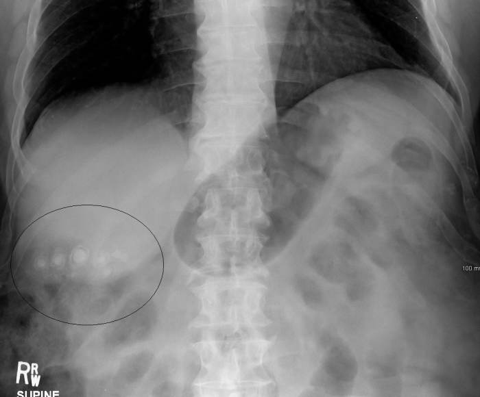 Gallstones (in the circle) as seen on an x-ray