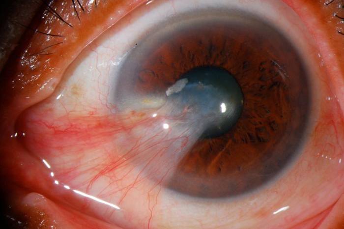 Left unchecked, a pinguecula can cross into the colored portion of the eye and interfere with vision. This condition is called pterygium, as shown in this severe case.