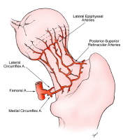 Avascular necrosis of the femoral head. Illustration of the normal circulation of the femoral head, viewed from the posterior approach. The posterior-superior retinacular arteries provide the major blood supply to the epiphysis. They traverse the fem