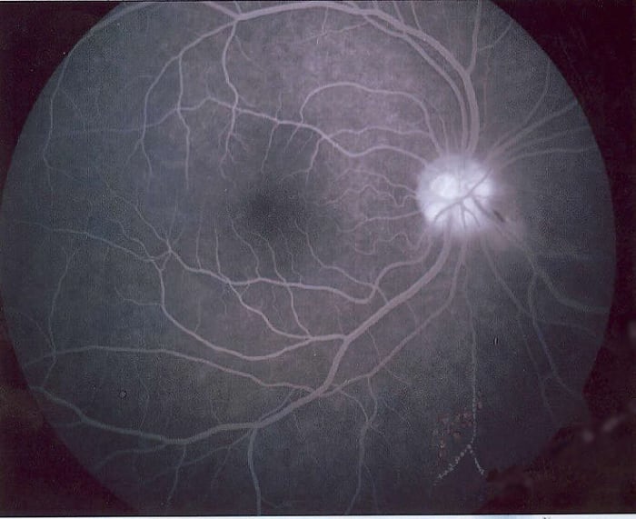 Angiography - black and white image of retina