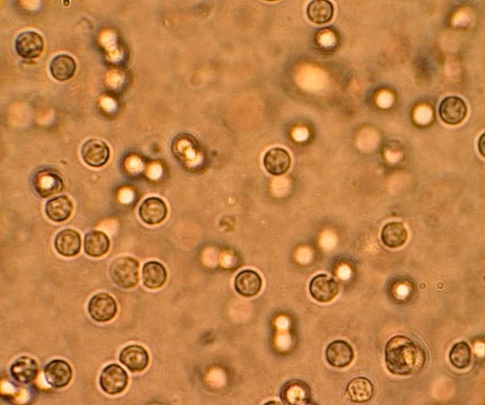 These are white blood cells in the urine of someone suffering from a urinary tract infection. The cells are part of the immune system.