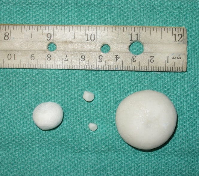 These are struvite stones from a dog's urinary bladder. The same stones form in humans during a Proteus mirabilis infection