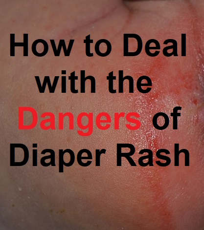 Most times diaper rash is uncomfortable for your baby but doesn't represent a risk to her health. However, it can be a sign of more serious conditions which parents should know about
