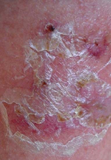 Microbial infection eczema presents as a persistent flakiness of the skin and a sore rash. In infants it may be mistaken for diaper rash and so go untreated. If in doubt, see a doctor without delay