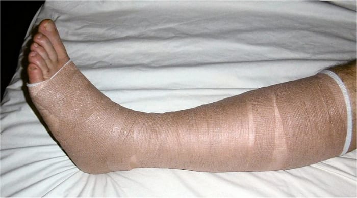 Leg bandages covered by a compression bandage.