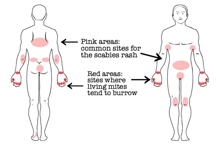The most common locations for scabies include the wrist, genitalia, lower abdomen, armpits, behind the elbows and knees, and in between the fingers and toes.
