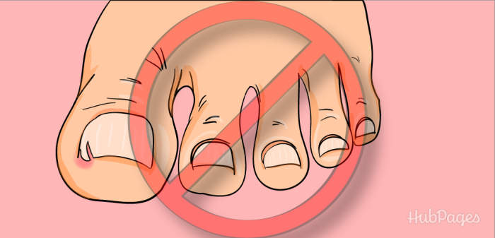 Do not cut your toenail further, as that increases the risk of infection. It is a myth that cutting a "V" into an ingrown toenail will help treat it.