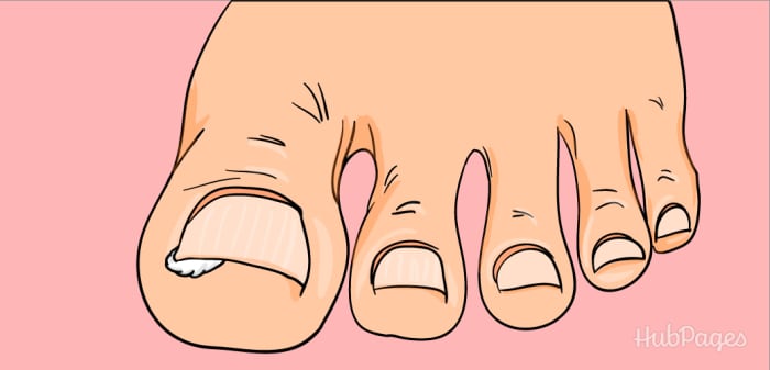 After soaking your ingrown toenail in hot water, place a piece of cotton underneath the edge that is ingrown so that the nail will begin to grow above the skin.