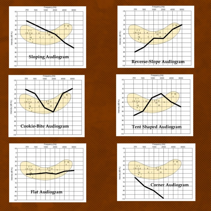 The Best Hearing Loss Simulations Understanding Audiograms and the