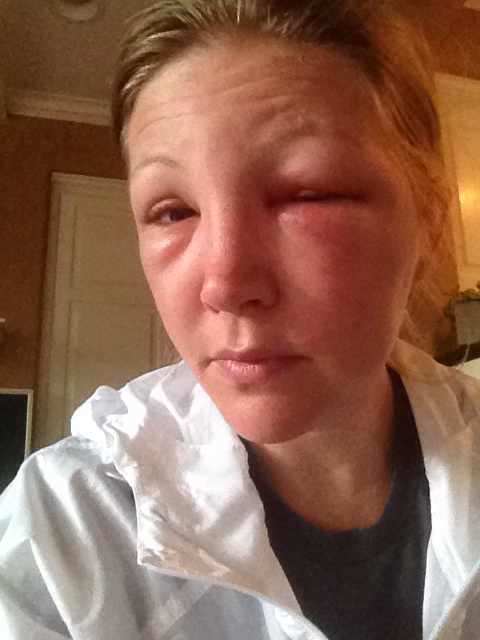 One day after bee sting to the eye. Began prescription medication 24 hours after initial sting.