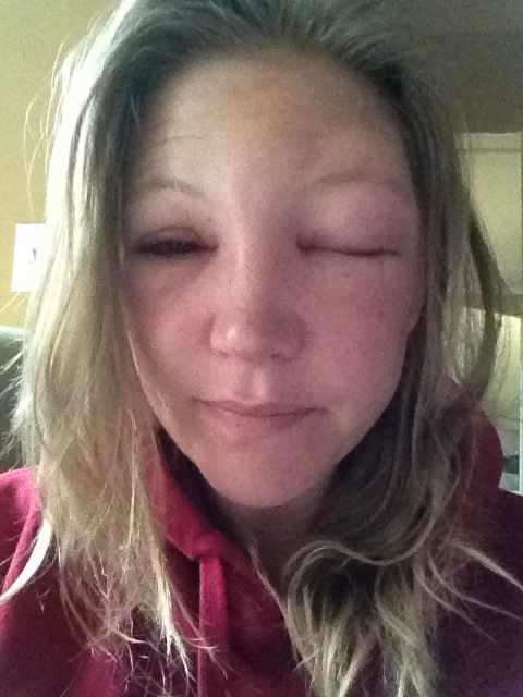 Morning after bee sting to the eyelid. One eye completely closed. This was a scary, almost claustrophobic, feeling. The second day was definitely the worst.