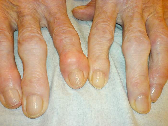 Heberden's and Bouchard's nodes sometimes appear in the fingers of a person suffering from osteoarthritis and may be associated with bone spurs.