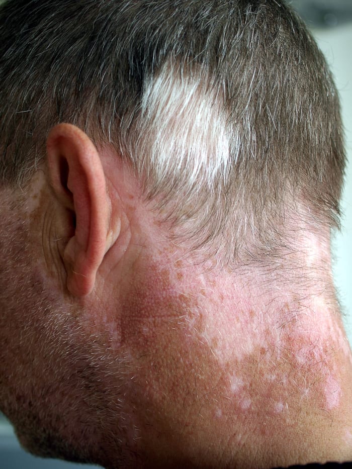 Vitiligo and poliosis (loss of pigment from hair)