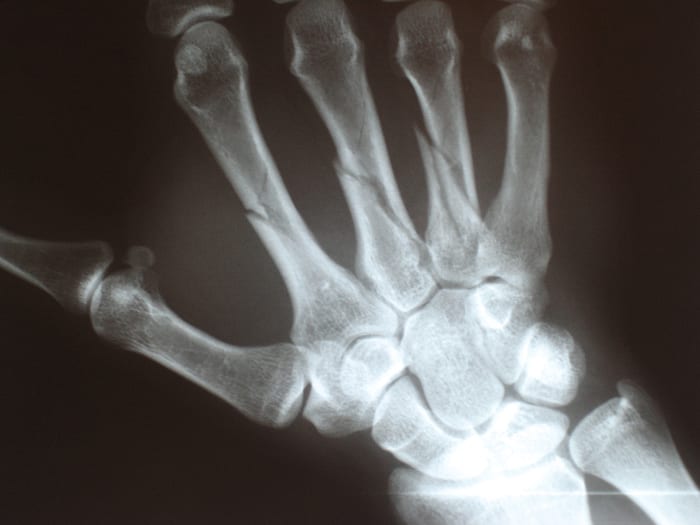 Hypercalcemia may lead to broken bones. The hand shown above has multiple fractures.