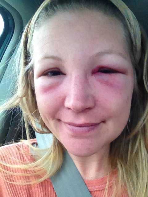 48 hours after bee sting to the eye. Began prescription medication the previous day. I finally went out of the house, although I wore sunglasses all day.