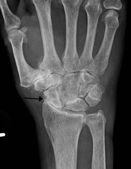 Severe osteoarthritis and osteopenia (loss of bone mineral density) of the carpal joint and 1st carpometacarpal joint.
