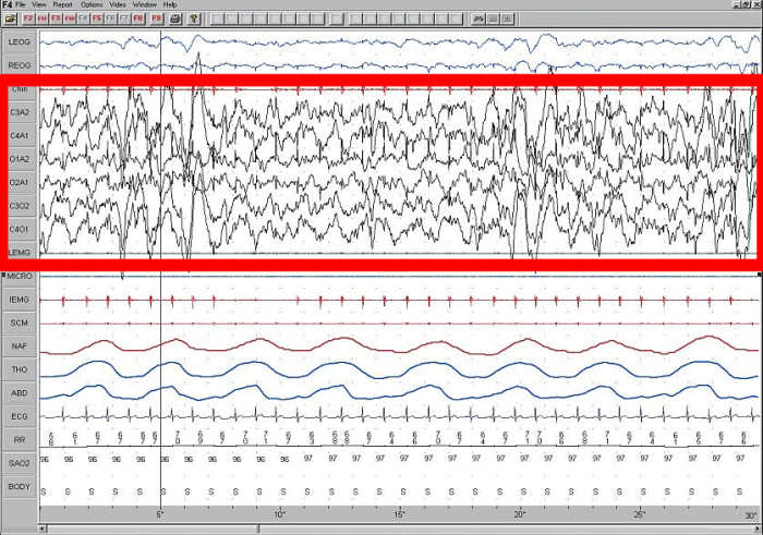 Slow wave sleep, as seen on this EEG, is indicative of a deep sleep. The sleeping person will be very difficult to rouse.