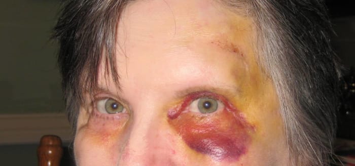 Most people don't have such a souvenir from norovirus, but fainting and falling gave me this one.