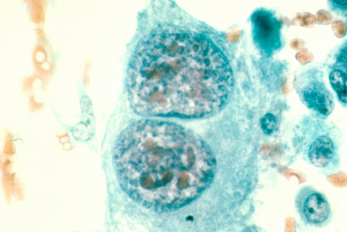 Osteosarcoma (Bone Cancer) Magnified 400x