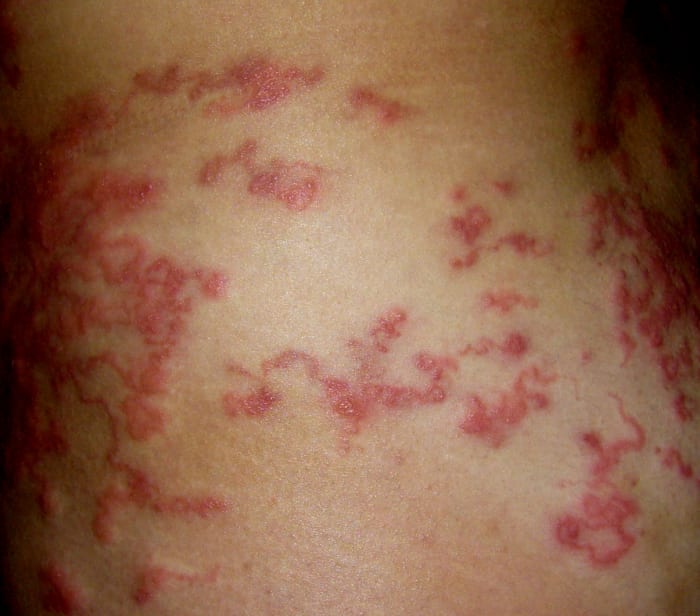 Heavy attack of larva migrans cutanea, hookworms under the skin.