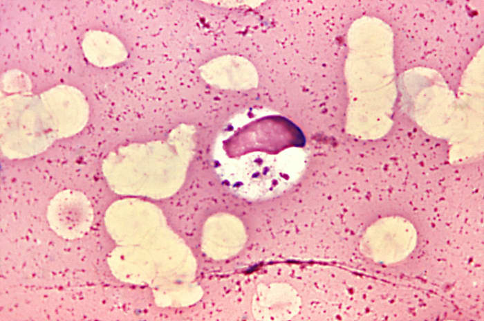 A stained specimen showing Leishmania inside a bone marrow cell