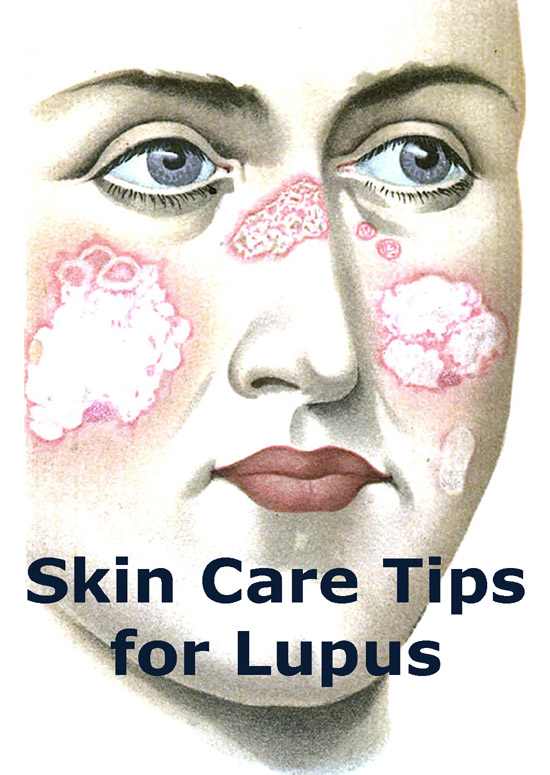 Illustration of woman with lupus rash on her face