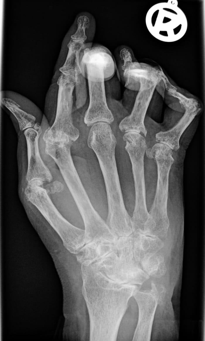 Deformity resulting from advanced rheumatoid arthritis