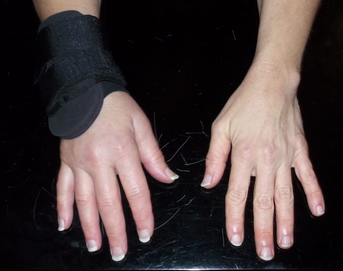 You can see that my right hand is still considerably bigger than my left hand, but the swelling has gone down an amazing amount. I get a little more movement & use every day. The pain seems to be mostly of the stiff muscle & tendon variety.