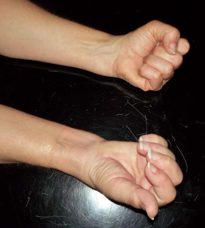 My Broken Wrist Experience YouMeMindBody Health Wellness