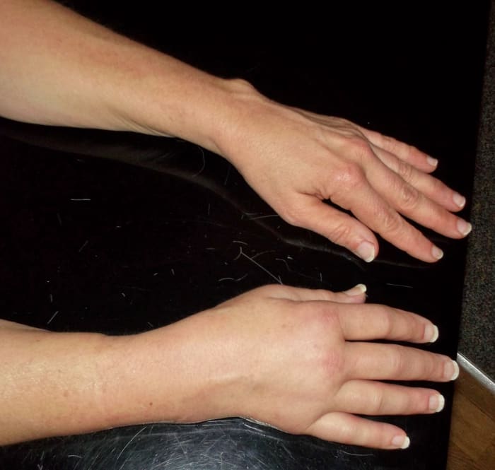 It wouldn't have turned out to be this crooked if I had been able to get in to see the orthopedic surgeon right away.