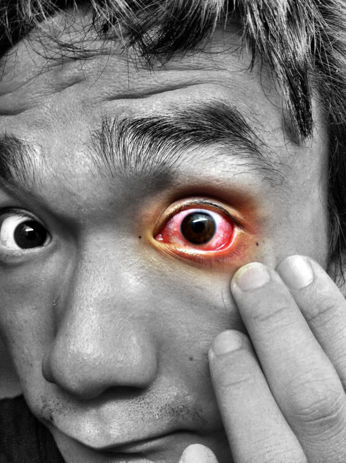 Why is my eye red, irritated, and teary? There are a number of potential causes. If in doubt, see an opthamologist.
