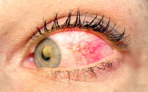 Scleritis feels as bad as it looks. The redness can be diffuse or concentrated in a pie shape, as in this photo. Pain is deep and penetrating.