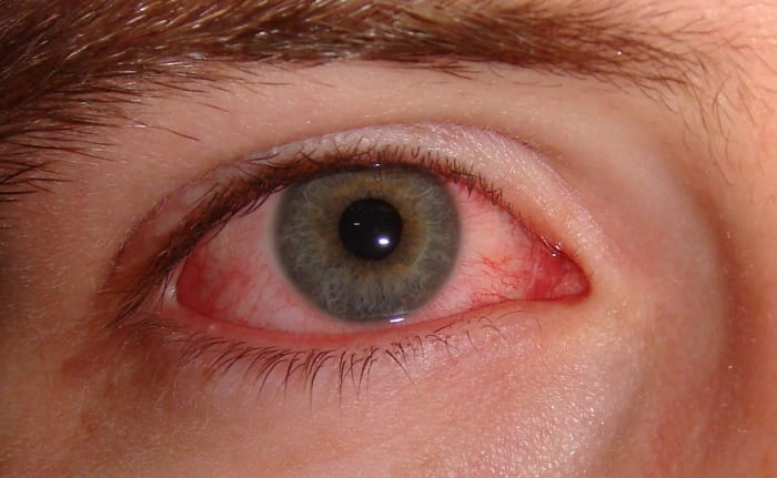 Pink eye can affect one or both eyes and may be highly contagious for up to two weeks after syptoms start.