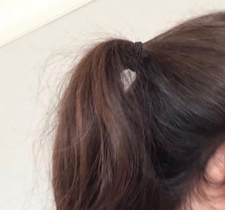 My hair at its thinnest, around 10 months after Accutane. I have since recovered (check next picture)!