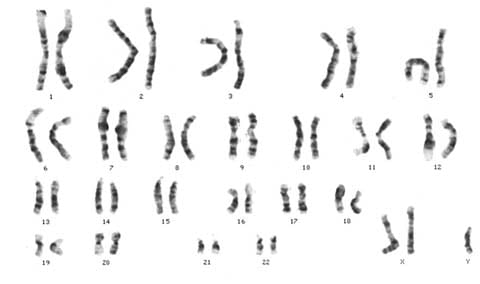 This karyotype provides a picture of the chromosomes taken through CVS or amniocentesis. This particular individual has two X chromosomes and a Y chromosome (XXY), consistent with Klinefelter's Syndrome.
