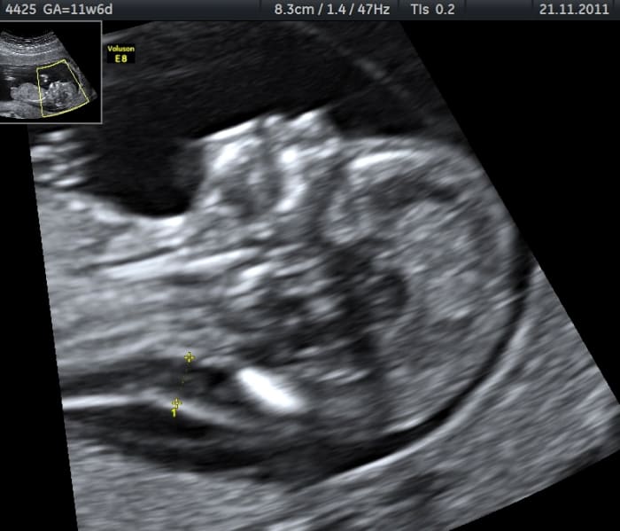Edema in the nuchal fold and an absence of a nasal bone are observed in this ultrasound at 11 weeks of gestation. This baby has Trisomy 21 (Down Syndrome), as confirmed by Chorionic Villus Sampling testing.