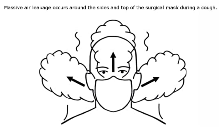 Figure 5. Front view of air leakage around a surgical mask, adapted from Figure 6, Section e in Tang et. al. (2009).