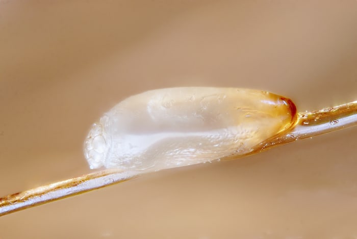 A nit of a head louse; the nit was photographed after a lice treatment and is dead