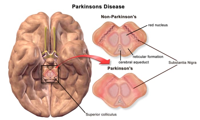 Brain cells in the substantia nigra die in Parkinson's disease. In this illustration, the brain is being viewed from below.