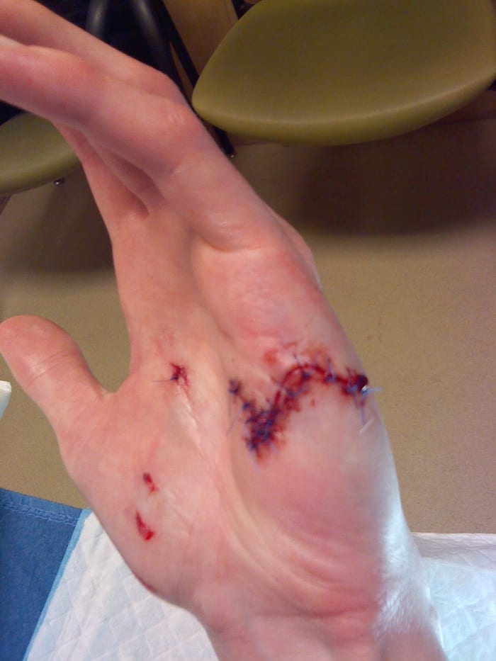 This is the worst of it—the other side had four more individual stitches to account for individual punctures.