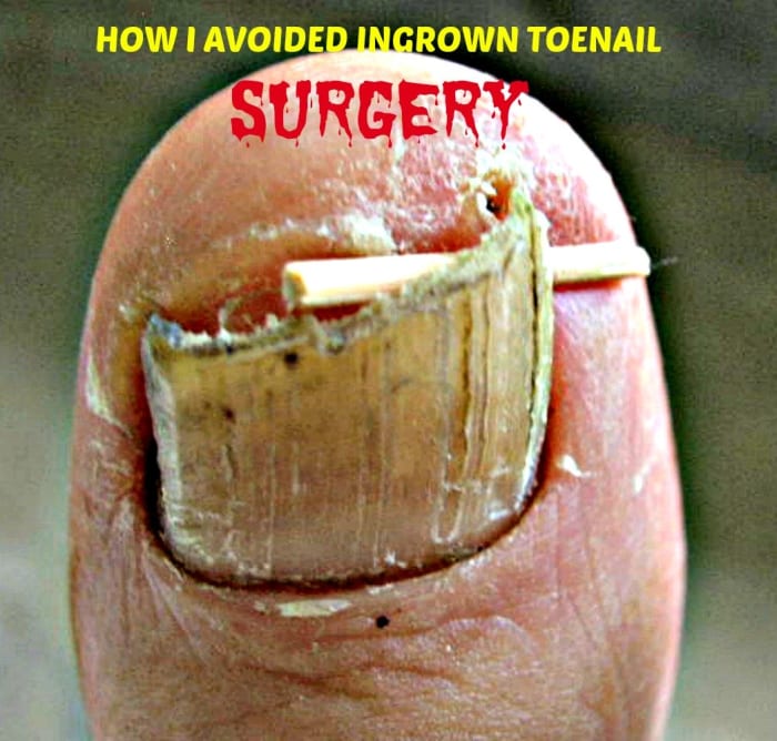 Some ingrown toenail home remedies work. Others do not. It's best to see a Podiatrist early so that you can avoid surgery.