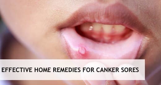 Canker sores are small lesions that commonly occur on the soft tissues in the mouth or at the base of the gums. What really causes these ulcers are poorly understood.
