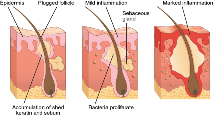 As you can see, it is the way our body reacts and tries to fight off the clog pore that causes inflammation, redness, and swelling. By gently cleansing you cause less irritation to the affected area.