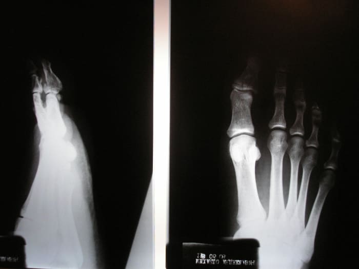 3-workouts-you-can-do-with-a-foot-injury