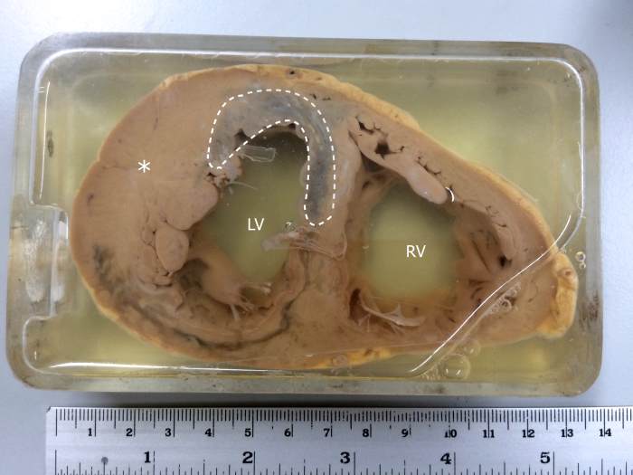 Specimen showing myocardial infarction in the left ventricle and the interventricular septum. The asterisk(*) also indicates left ventricular hypertrophy.