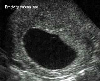 This is not my ultrasound picture, but this is what the doctor will see if you have a blighted ovum. There is an empty gestational sac with no yolk sac or fetus visible.