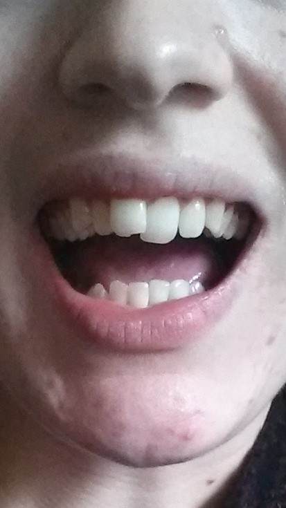 To give you some idea of the treatment I went through, this is a photo of my teeth before I had any treatment. I had over-crowding, which had pushed my front teeth to overlap, and I had very crooked bottom teeth. I also had a slight over-bite.